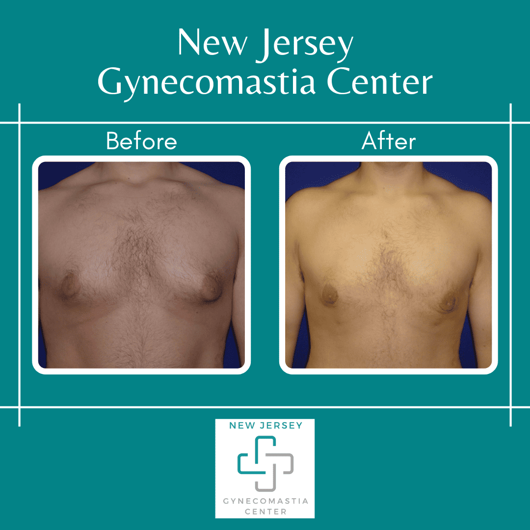 The Relationship Between Gynecomastia and Pain: How to Deal With It?