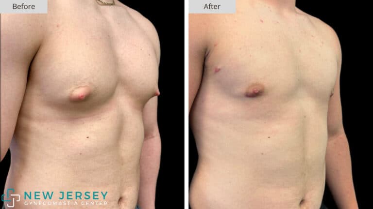 NJ Gynecomastia 101b