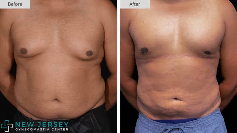 NJ Gynecomastia 102a