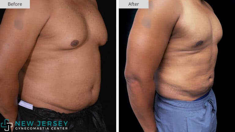 NJ Gynecomastia 102b