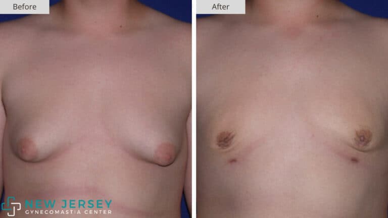 1. New Jersey Gynecomastia Before and After Stage 3