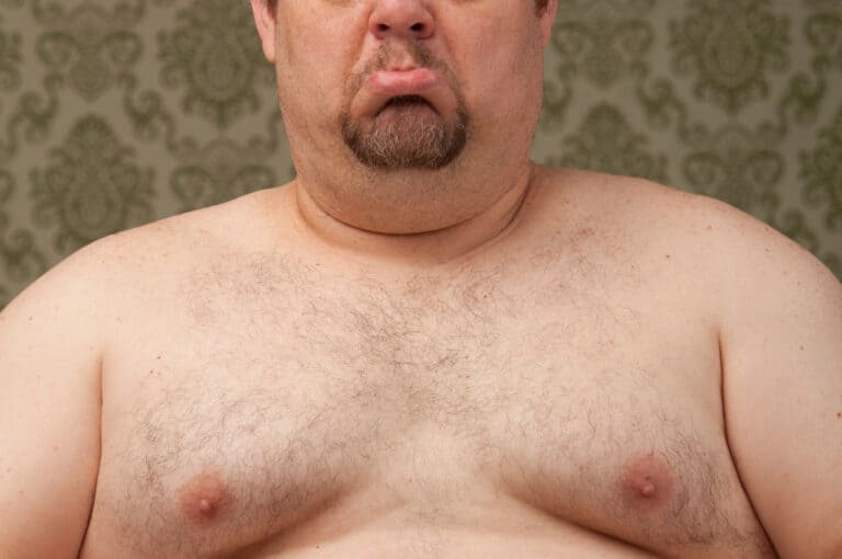 Coolsculpting for gynecomastia