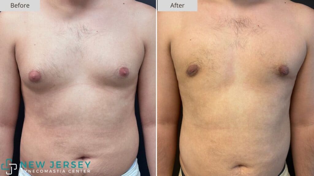 New Jersey Gynecomastia Before & After