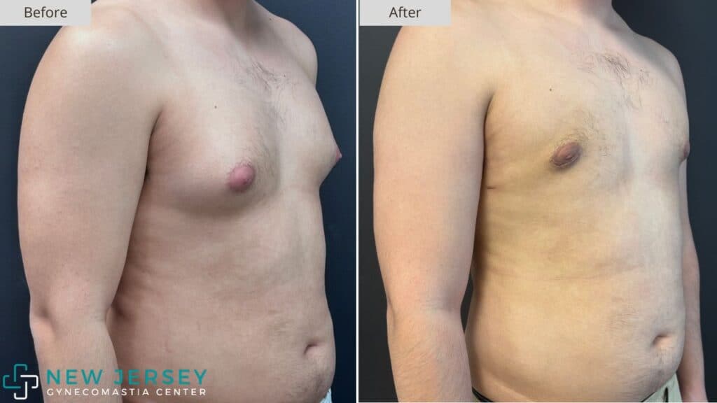New Jersey Gynecomastia Before & After