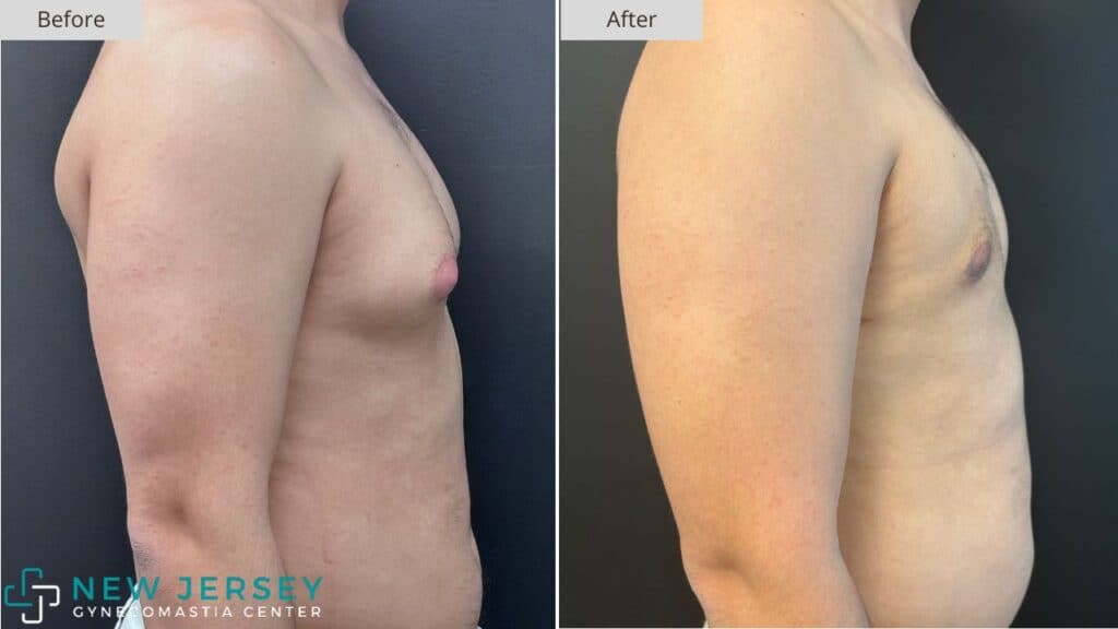 New Jersey Gynecomastia Before & After