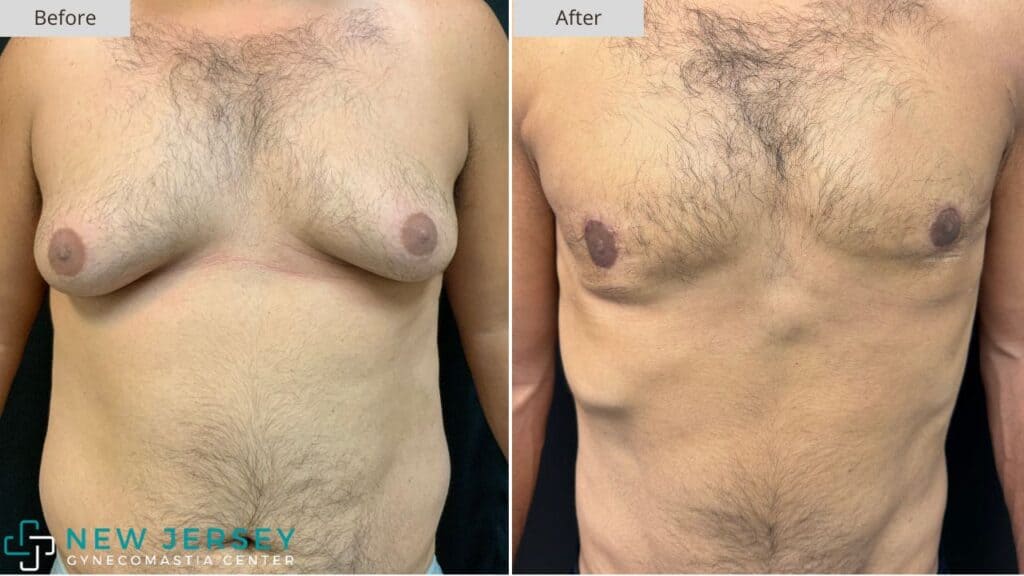 New Jersey Gynecomastia Before & After