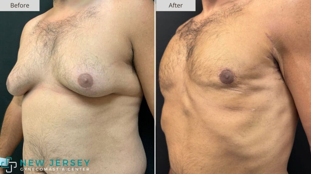 New Jersey Gynecomastia Before & After