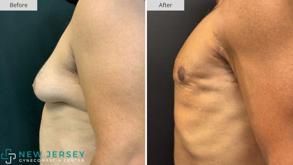 New Jersey Gynecomastia Before & After