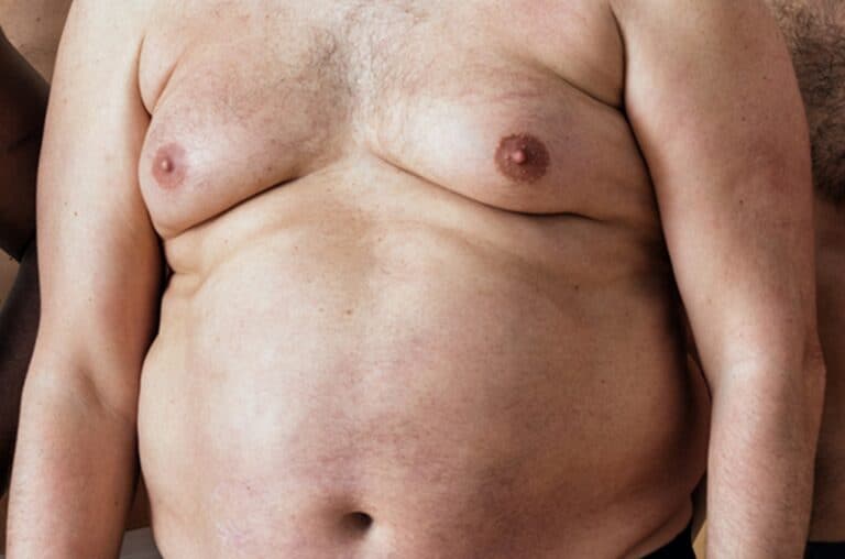 close up severe chest growth